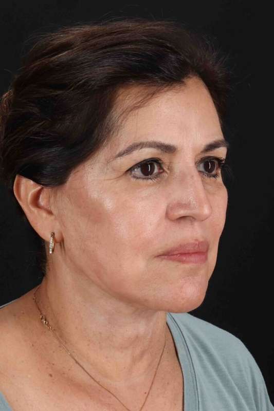 Facelift Before & After Patient #5284