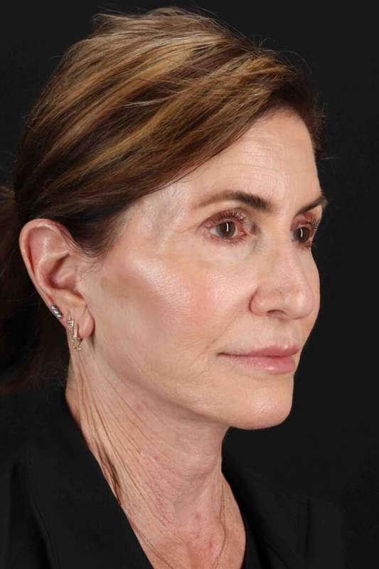 Facelift Before & After Patient #5337