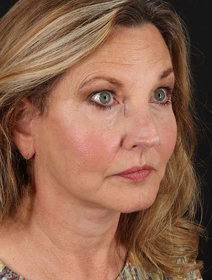 Facelift Before & After Patient #5348