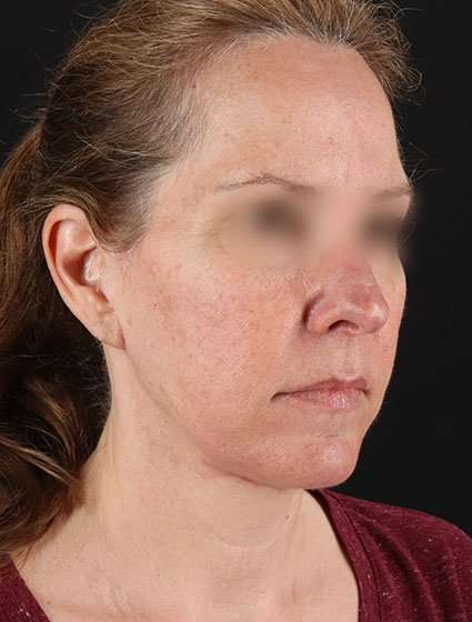 Facelift Before & After Patient #5359