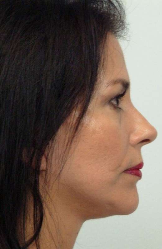 Facelift Before & After Patient #5367
