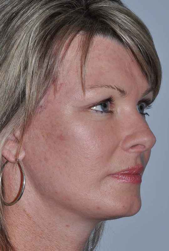 Facelift Before & After Patient #5385