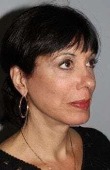Facelift Before & After Patient #5399