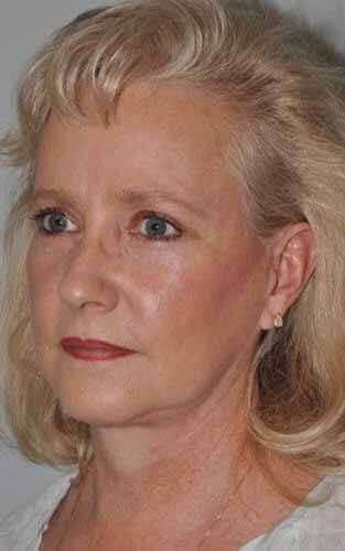 Facelift Before & After Patient #5424