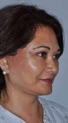 Facelift Before & After Patient #5438