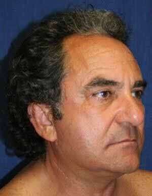 Facelift Before & After Patient #5452