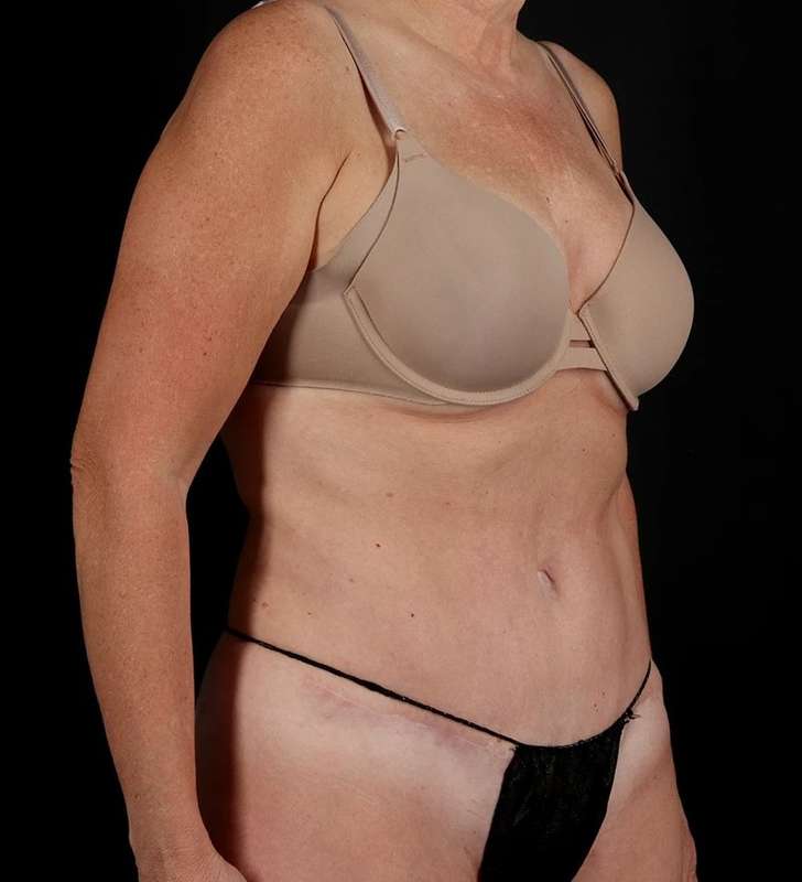 Abdominoplasty (Tummy Tuck) Before & After Patient #1029