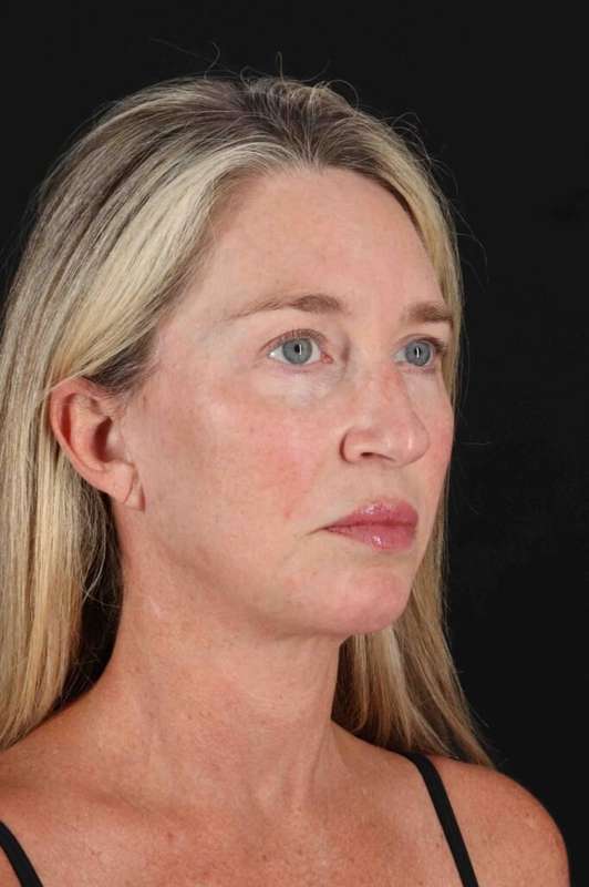 Facelift Before & After Patient #5488