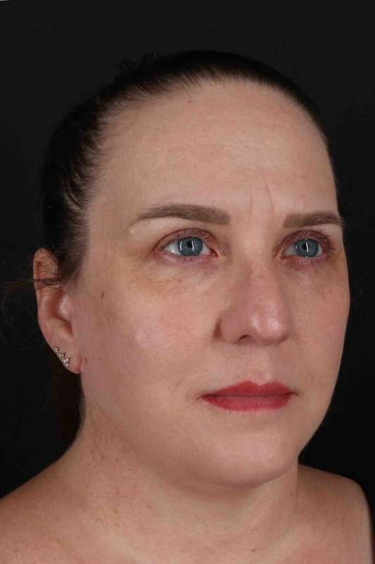 Facelift Before & After Patient #5521