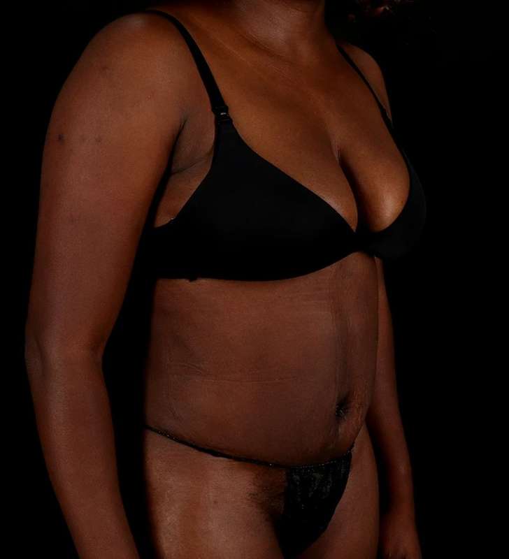 Abdominoplasty (Tummy Tuck) Before & After Patient #1045