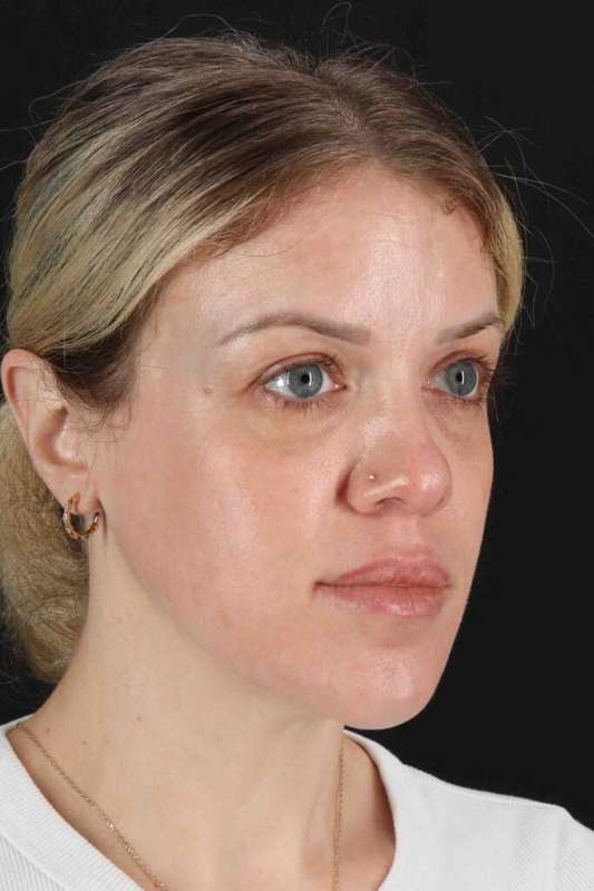 Chemical Peels Before & After Patient #5601