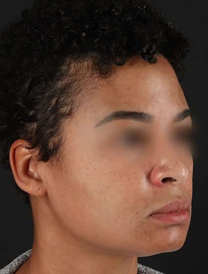 Chemical Peels Before & After Patient #5610