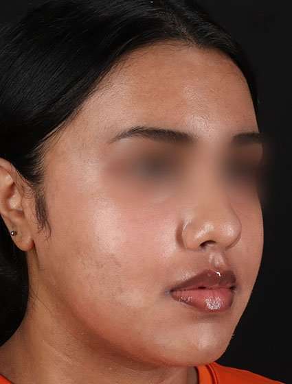 Chemical Peels Before & After Patient #5621