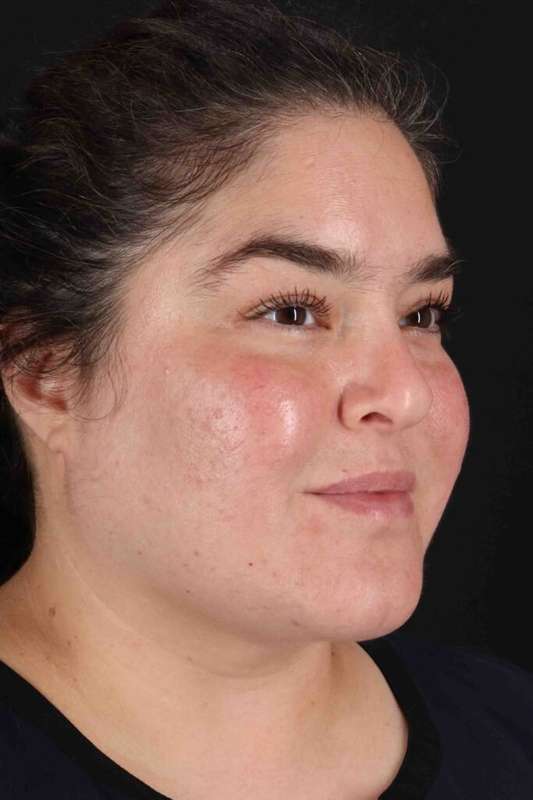 Neck Liposuction Before & After Patient #5643