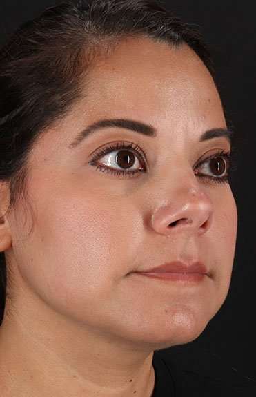 Neck Liposuction Before & After Patient #5720