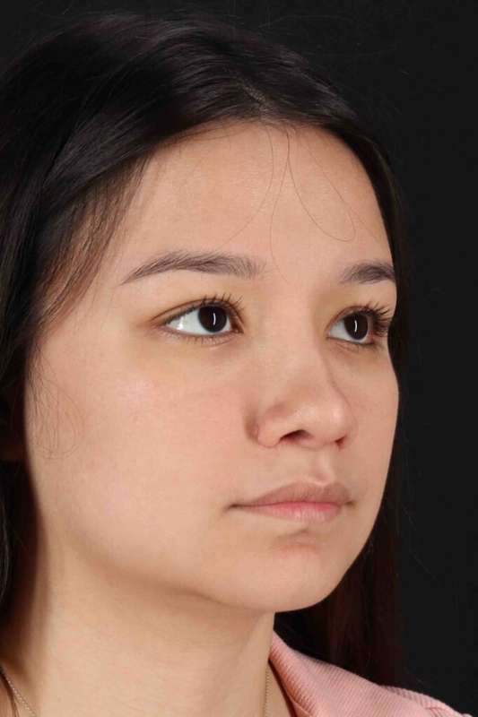 Rhinoplasty Before & After Patient #5837