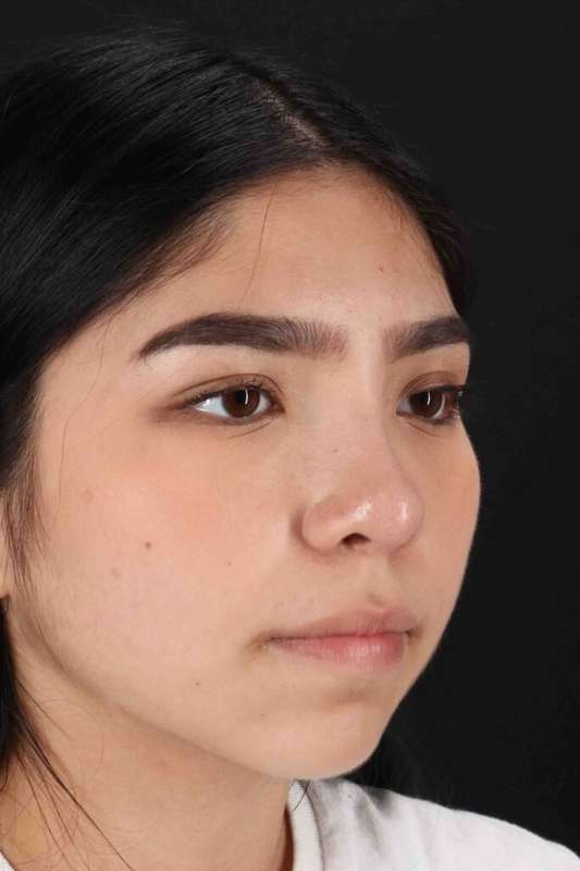 Rhinoplasty Before & After Patient #5848