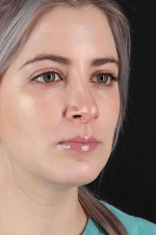 Rhinoplasty Before & After Patient #5859