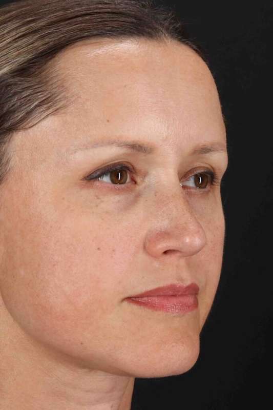 Rhinoplasty Before & After Patient #5870