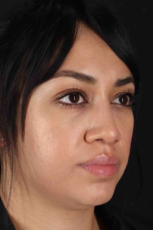 Rhinoplasty Before & After Patient #5881