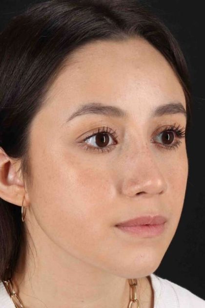 Rhinoplasty Before & After Patient #5892