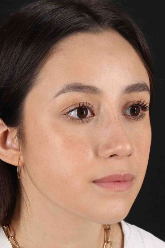 Rhinoplasty Before & After Patient #5892