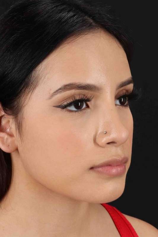 Rhinoplasty Before & After Patient #5903