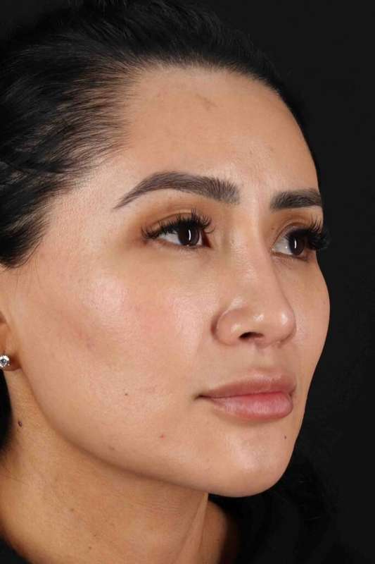 Rhinoplasty Before & After Patient #5925