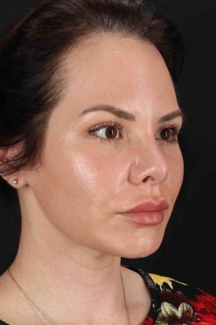 Rhinoplasty Before & After Patient #5936