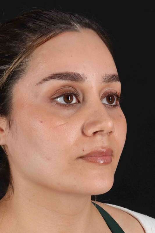 Rhinoplasty Before & After Patient #5947