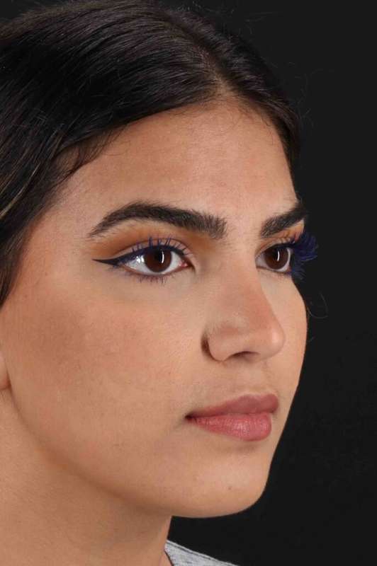 Rhinoplasty Before & After Patient #5958