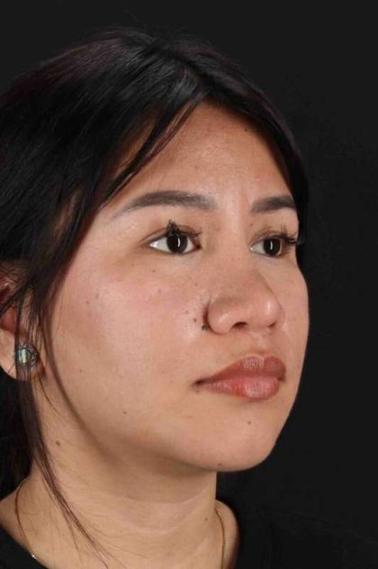 Rhinoplasty Before & After Patient #5983