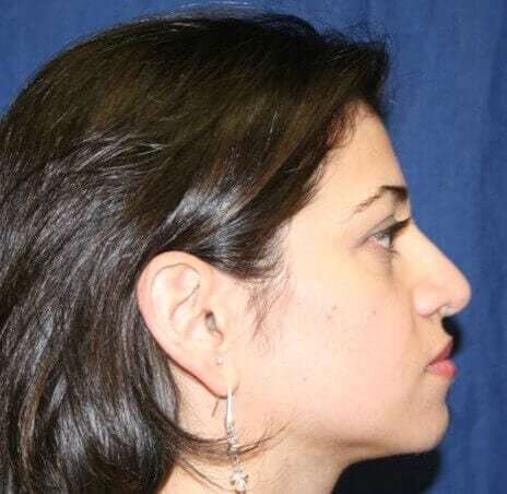 Rhinoplasty Before & After Patient #6021