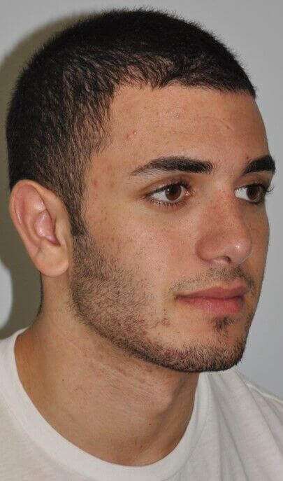 Rhinoplasty Before & After Patient #6028
