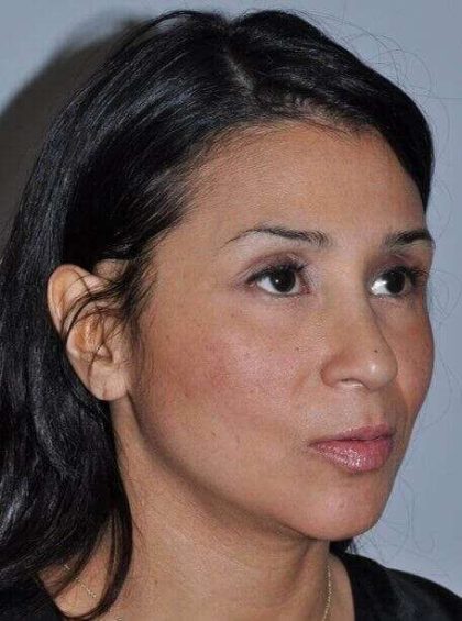 Rhinoplasty Before & After Patient #6035