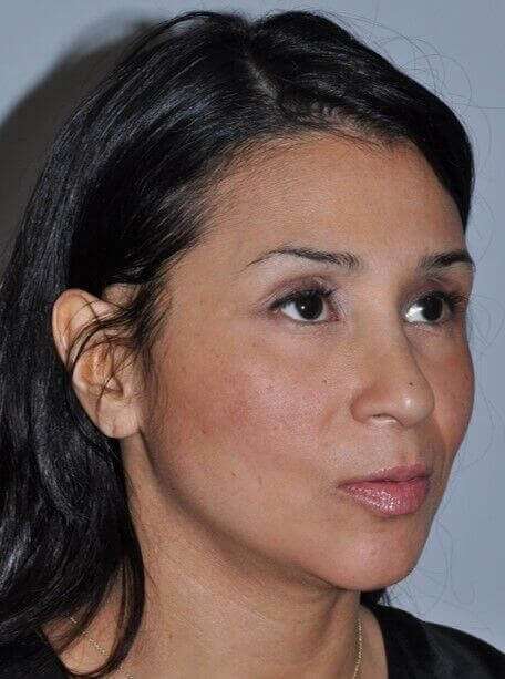 Rhinoplasty Before & After Patient #6035