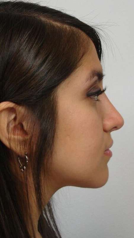 Rhinoplasty Before & After Patient #6040