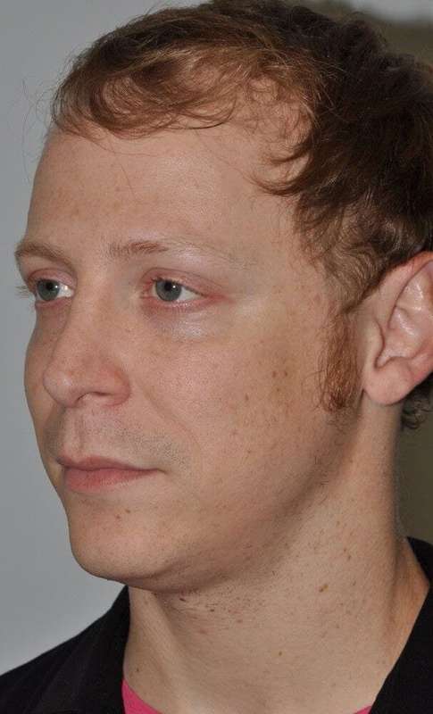 Rhinoplasty Before & After Patient #6047
