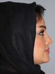 Rhinoplasty Before & After Patient #6054