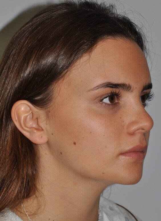 Rhinoplasty Before & After Patient #6075
