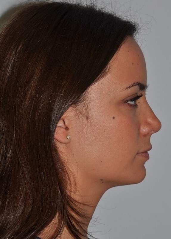 Rhinoplasty Before & After Patient #6080