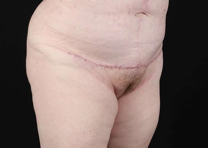 Monsplasty Before & After Patient #1117