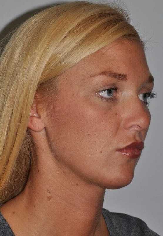 Rhinoplasty Before & After Patient #6087