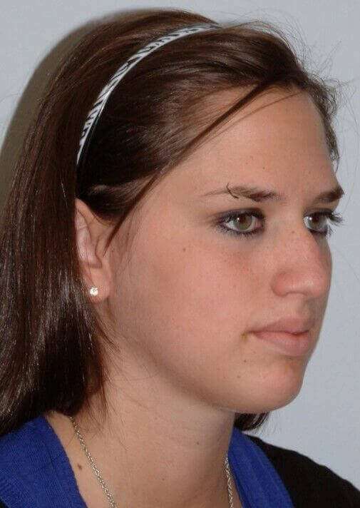 Rhinoplasty Before & After Patient #6092