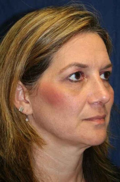 Rhinoplasty Before & After Patient #6099