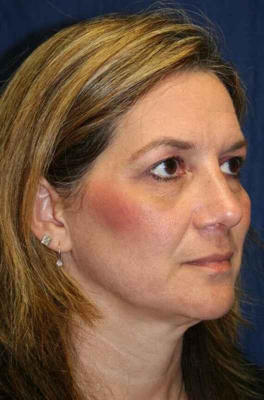 Rhinoplasty Before & After Patient #6099