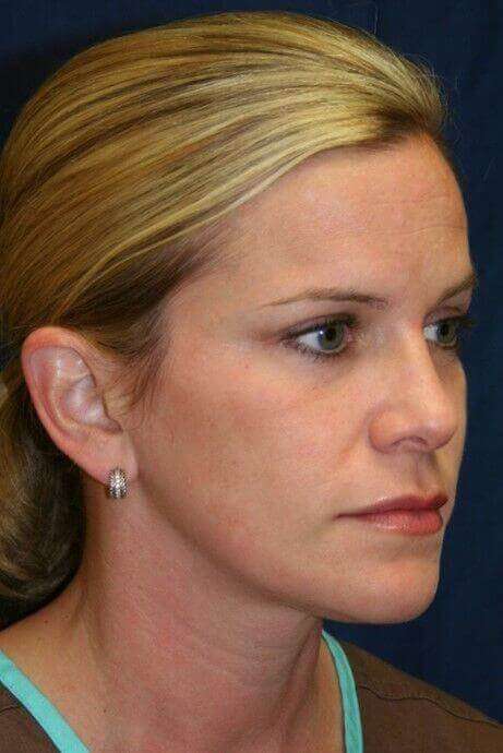 Rhinoplasty Before & After Patient #6106