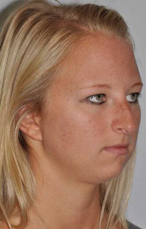 Rhinoplasty Before & After Patient #6113