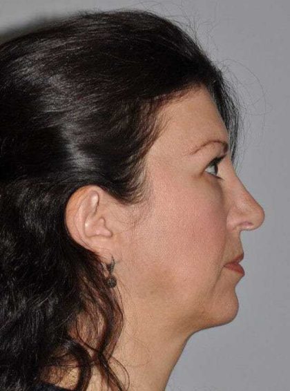 Rhinoplasty Before & After Patient #6125