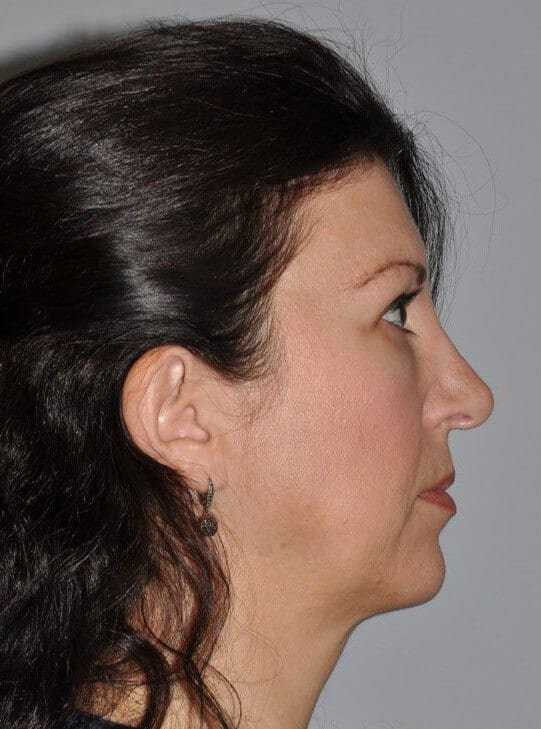 Rhinoplasty Before & After Patient #6125
